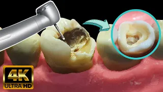 Endodoncia en muela con caries profunda - Tratamiento de conducto