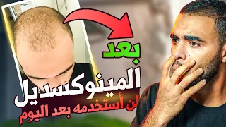 !!لن أستخدم المينوكسديل على شعري منذ اليوم، وهذا هو السبب
