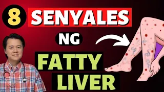 8 Senyales ng Fatty Liver. Bantayan ang Atay Natin.- By Doc Willie Ong (Internist & Cardiologist)