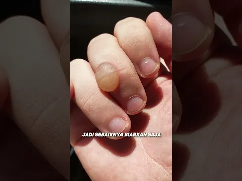 Apakah Kita Seharusnya Pecahin Gelembung 'Kapalan' Atau Lebih Baik Jangan? 🤔🤔