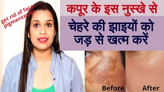 कपूर के इस नुस्खे से चेहरे की झाइयों को जड़ से खत्म करें || pigmentation treatment at home