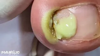 A UNHA FEZ UM BURACO NO DEDO DELE #viral #podologomaurelio #ingrowntoenail