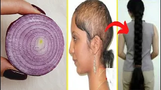 الوصفة المعجزة لانبات فراغات الشعر و الصلع في أسبوع والله النتيجة ستبهرك سيصبح مثل شعر الهنديات
