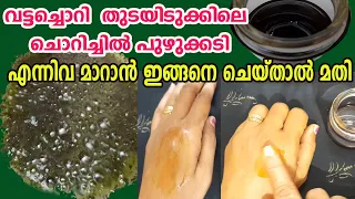 വട്ടച്ചൊറി,തുടയിടുക്കിലെ ചൊറിച്ചിൽ,പുഴുക്കടി എന്നിവ മാറാൻ  Ringworm Vattachori Maran Malayalam