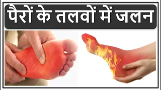पैरों के तलवों में जलन का इलाज, पैरों में जलन होने से कौन सी बीमारी होती है?, Burning Feet Treatment