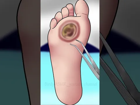 ASMR maggots treatment#asmr #animation #satisfying #viral #shorts #short