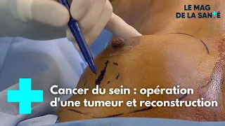 Une seule opération pour retirer une tumeur et reconstruire un sein - Le Magazine de la Santé