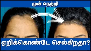How To Treat Forehead Hair Loss : Treatment for FAST REGROW