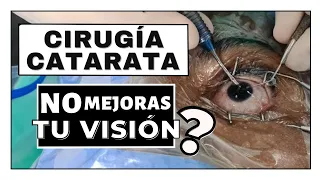 7 Causas de VISIÓN BORROSA después de una Cirugía de Cataratas?