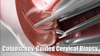 Sampling abnormal cervical tissue for cancer
