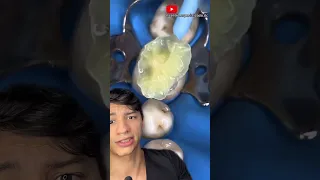 Dentista ESCONDEU a CÁRIE no próprio DENTE ? E AGORA ?!