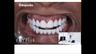 This is how we close gaps with #veneers