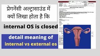 प्रेगनेंसी में  internal os is closed का क्या मतलब है | internal vs external os in pregnancy