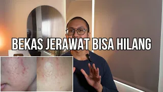 Cara menghilangkan bekas jerawat
