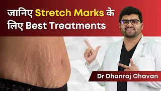 Stretch Marks के लिए Best treatment क्या है? | Dr Dhanraj Chavan: Clear Skin Pune