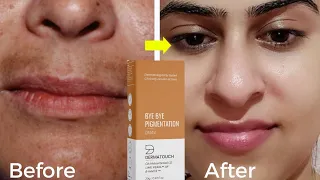 जिद्दी झाइयां खत्म करने के बेस्ट क्रीम |Dermatouch bye bye pigmentation cream | Brijwasi Girl