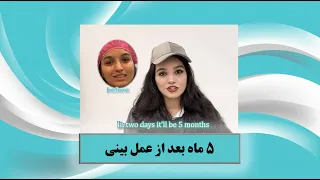 بازیگر سریال زخم کاری - 5 ماه بعد از عمل بینی