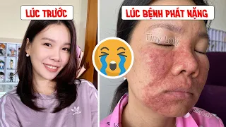 Bệnh viêm da dị ứng đã làm mình khóc rất nhiều + Kinh nghiệm điều trị