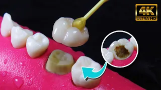 INCREIBLE restauración de diente dañado por caries: Corona en 4K