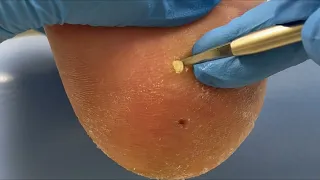 Small hard objects under foot calluses & foot care【Xue Yidao】