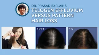 Differences Between Telogen Effluvium, and Genetic Pattern Hair Loss