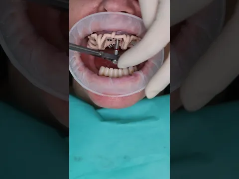 Dental implant’s All on 4 in Prague #shorts #dentist #dental #implant #veneers #short
