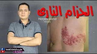 الحزام الناري / Herpes zoster
