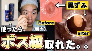 【毛穴の黒ずみ取れる】全然取れなかった爆弾級のいちご鼻が取れたアイテム‼️‼️