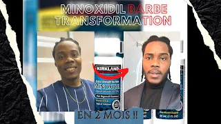 AVOIR UNE BARBE EN SEULEMENT 2 MOIS (MINOXIDIL 5%) RÉSULTAT ?