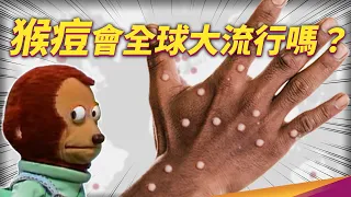 台灣本土猴痘/M痘進來了！ 「人傳人」症狀、傳染途徑有哪些？沒疫苗那有藥醫嗎？