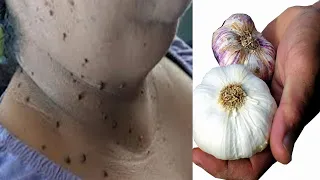 diy skin tag removal in 3 day  / skin tag removal natural remedies with lemon remedy