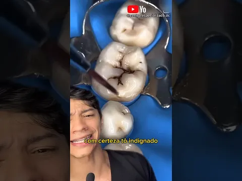 “Esse Dentista é Doido, Escondeu a Cárie dentro do dente?!” Veja até o Final…#shorts