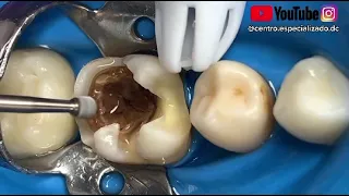 ¡Eliminando caries profunda de una muela!