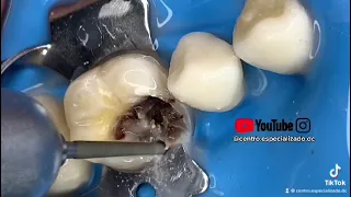 ¡Doctor! “tengo un hoyito pequeño en la muela”