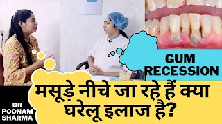 मसूड़े नीचे जा रहे है रोकने के घरेलू इलाज | Home Remedies For Gum Recession | Receding Gums Treatment