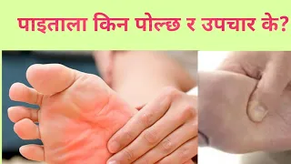 पाइताला किन पोल्छ, उपचार के छ?Burning feet in Nepali|Dr Bhupendra Shah|doctor sathi