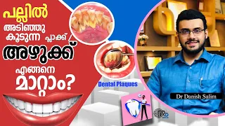 1096: 🦷 പല്ലിൽ അടിഞ്ഞു കൂടുന്ന പ്ലാക്ക് / അഴുക്ക് എങ്ങനെ മാറ്റാം? Dental plaques & teeth cleaning