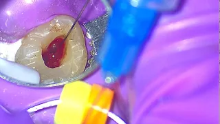How to Stop a Bleeding Canal