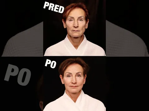 Zobral som mamu na plastickú operáciu (PRED A PO)
