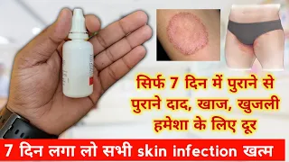 सिर्फ 7 दिन में पुराने से पुराने दाद, खाज, खुजली हमेशा के लिए दूर | Dad khaj khujli best medicine