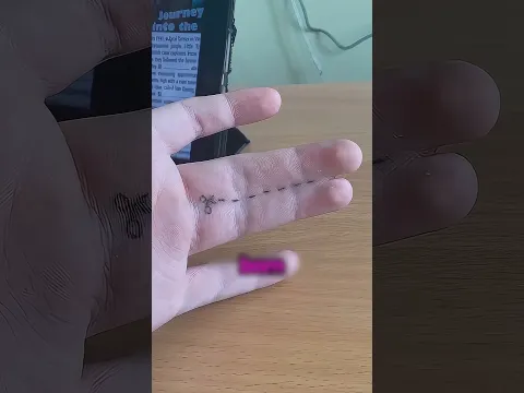 ছেলেটার আঙ্গুল দুটো জন্মগত থেকে লাগানো #facts