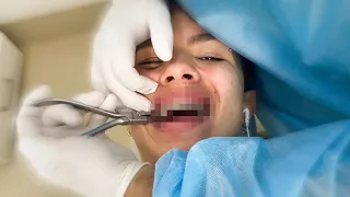 TIREI O APARELHO DEPOIS DE 6 ANOS!!