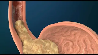 What Causes GERD?