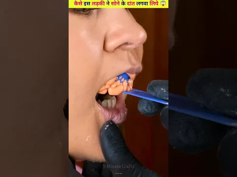 OMG 😳 सोने के दांत लगवा लिए 😱 #viralshort #viralvideo #shortsfeed