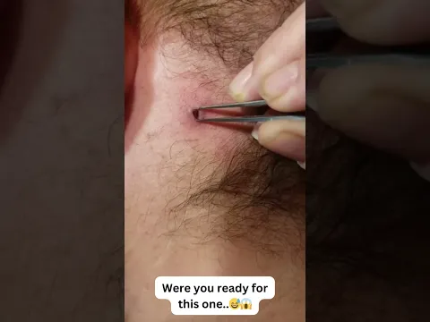 What’s your favourite extraction?